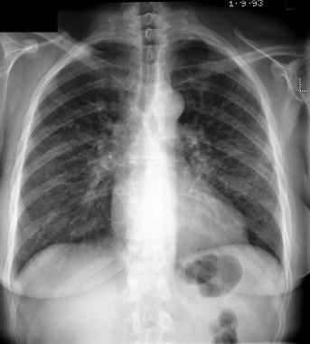 Standard chest radiograph shows methotrexate toxic