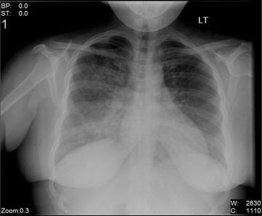 pneumonia chest x ray compared to normal