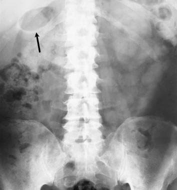 Plain abdominal radiograph in a 49-year-old diabet