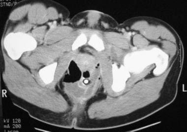 Crohn disease. Perianal abscesses. CT scan demonst
