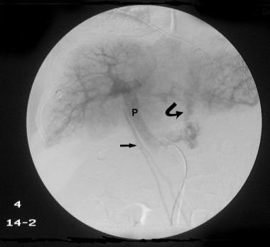Delayed venous phase of a selective common hepatic