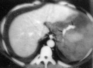 Spleen, trauma. Contrast-enhanced CT scan shows a 