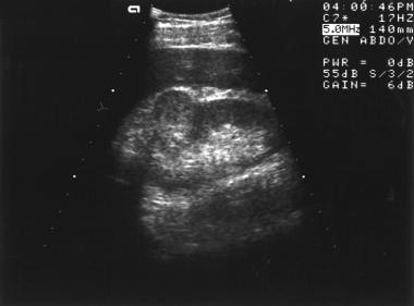 Ultrasonogram obtained in a 48-year-old man who pr