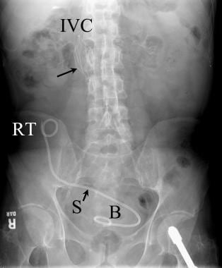 Abdominal radiograph following renal transplantati