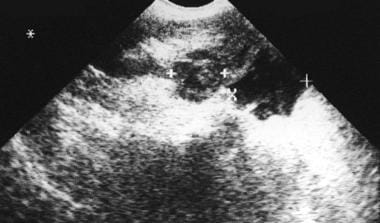 Sonogram in a 62-year-old woman who presented with