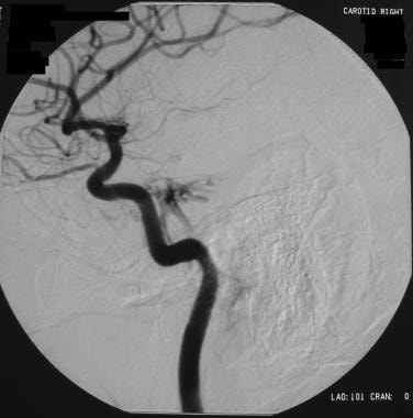 Selective right carotid angiogram from a patient w