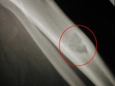 Radiograph of the tibia of a 15-year-old girl reve