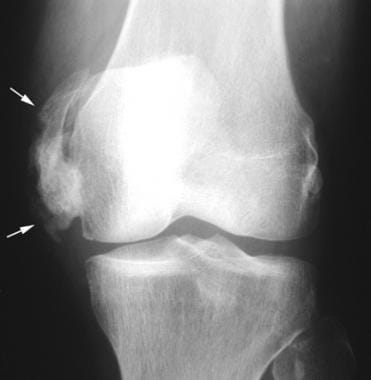 Anteroposterior radiograph of the left knee in a p