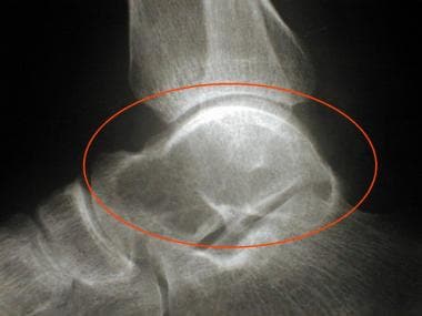 Lateral radiograph of the ankle. 