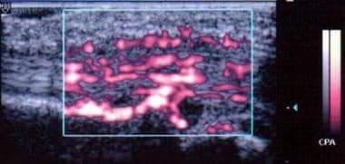 Power Doppler image shows hyperemic blood flow in 