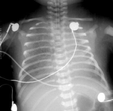 Initial anteroposterior radiograph of the chest in