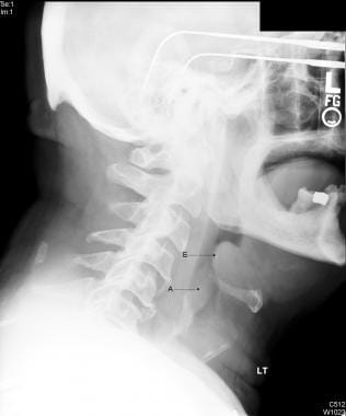 Image in a 66-year-old patient with acute epiglott