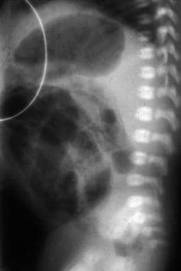 Lateral abdominal image shows pneumatosis intestin