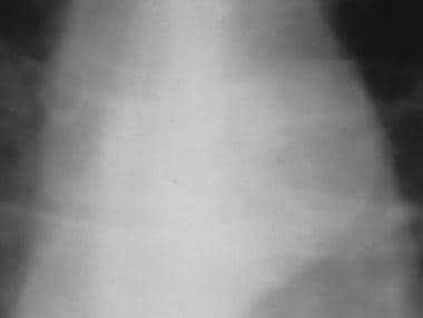 Aorta, trauma. Image shows the contour deformity a