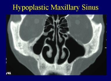 Hypoplastic right maxillary sinus. 