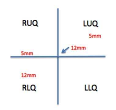 Trocar configuration. Abbreviations: LLQ, left low