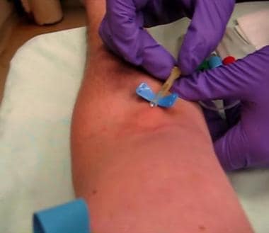Phlebotomy. Insertion of winged butterfly device, 