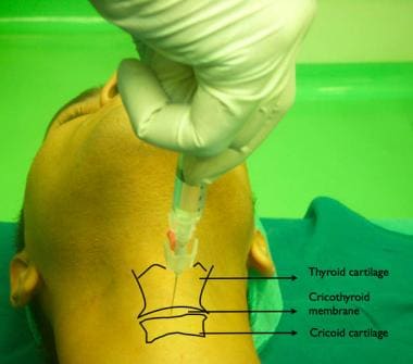 Trans tracheal block. An intravenous cannula is in