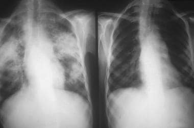 Chest radiograph showing patchy diffuse pulmonary 