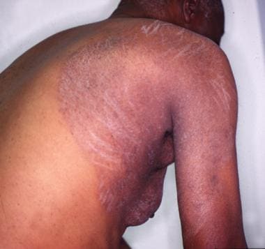 Tinea Corporis Clinical Presentation: History, Physical Examination