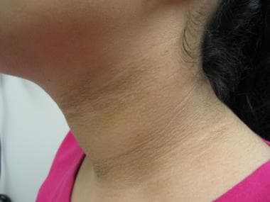 acanthosis nigricans neck