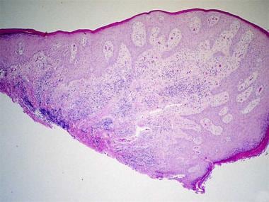 Photomicrograph showing the histologic features of