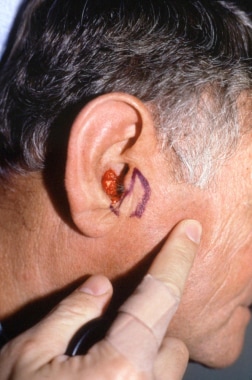 Postoperative Mohs defect in the right concha of a