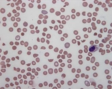 Peripheral smear in hemolytic uremic syndrome, wit