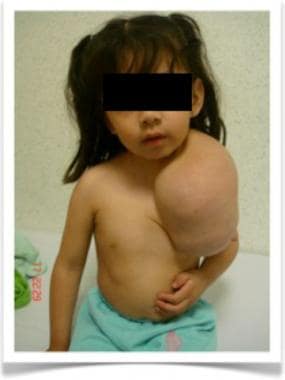 Clinical image of 3-year-old girl with large macro