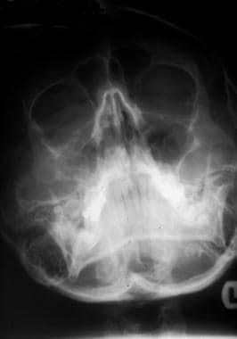 zygomatic arch radiograph