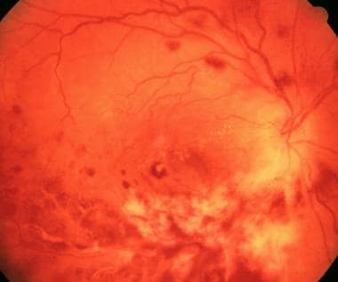 White granular retinitis with intraretinal hemorrh