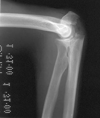 Lateral radiograph of elbow in 78-year-old man who
