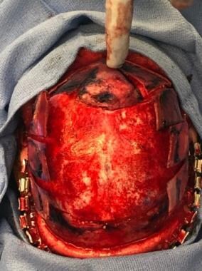 Intraoperative view of sagittal craniosynostosis a