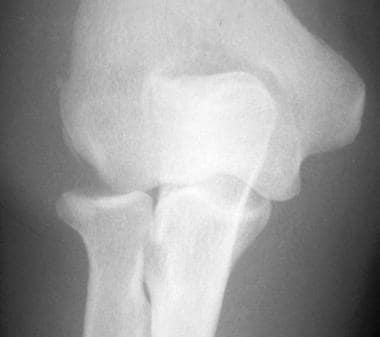 Isolated radial head dislocation is almost always 