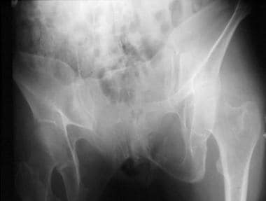 Outlet pelvis radiograph. 