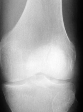 patella fracture