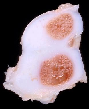 Fibular hemimelia. Clinical photograph of specimen