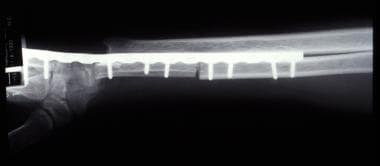 Postoperative lateral radiograph of same giant cel