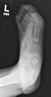 Oblique view of left foot. Medial ankle and subtal