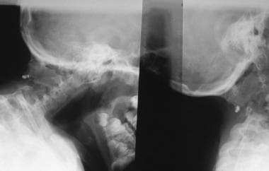 A photograph of a child with Sprengel's deformity: (A) asymmetry of