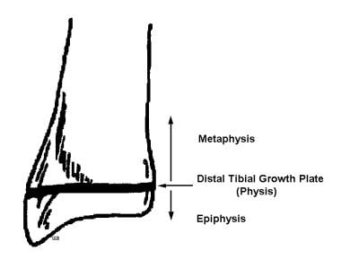 Triplane fracture involves the tibial metaphysis, 