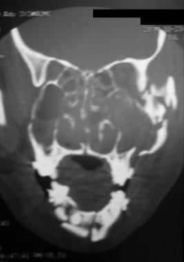 Coronal view of patient with panfacial fractures f