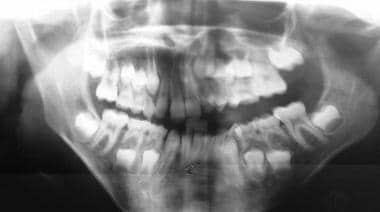 Panorex showing mandibular hypertrophy due to a ly