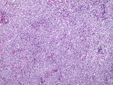 Diffuse large B cell lymphoma under low magnificat