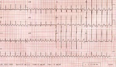 Atrial flutter. The patient's heart rate is approx