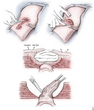 P-SS-52 Anti-bedsore cushion for the lower limbs