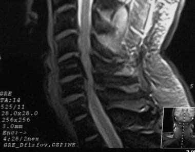 T2-weighted sagittal MRI of the cervical spine dem