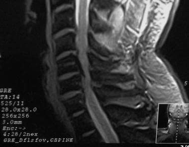 Cervical spine stenosis - London Neurosurgery - Spine