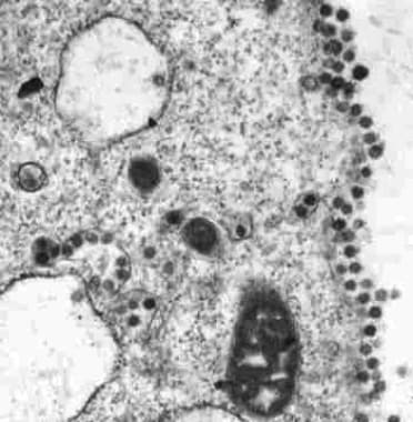 Thin-section electron micrograph of the severe acu