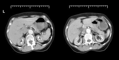 Axial CT scans from patient with long history of r